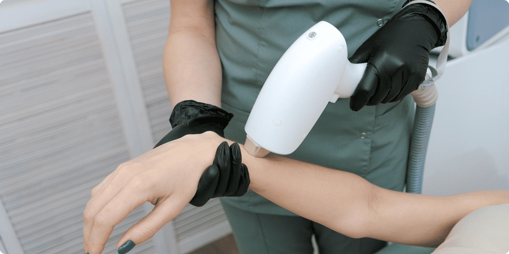 Les bénéfices de l'épilation laser
